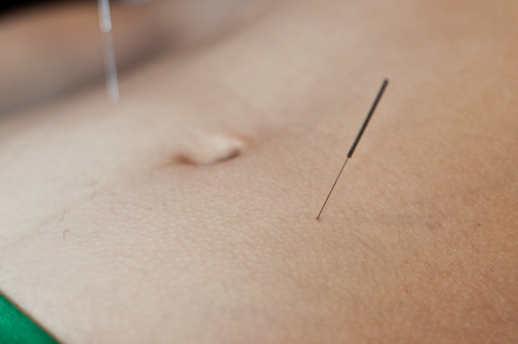 Acupuncture for digestion at Atmosphere Health in Calgary